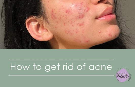 Best ways to get rid of acne